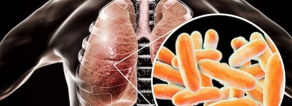 Health Department Investigating Legionnaires’ Disease Cluster on the Upper East Side